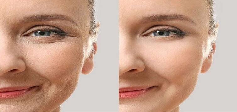 The difference between Botox and Fillers is assessed by the mechanism of action and the time it takes to maintain efficiency