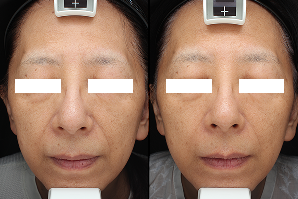 Điều trị rãnh mũi má với HIFU