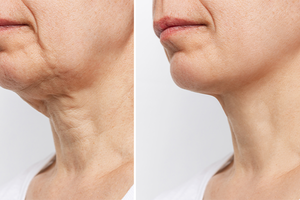 Điều trị nọng cằm với HIFU