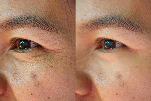 Điều trị bọng mắt và nếp nhăn đuôi mắt với HIFU