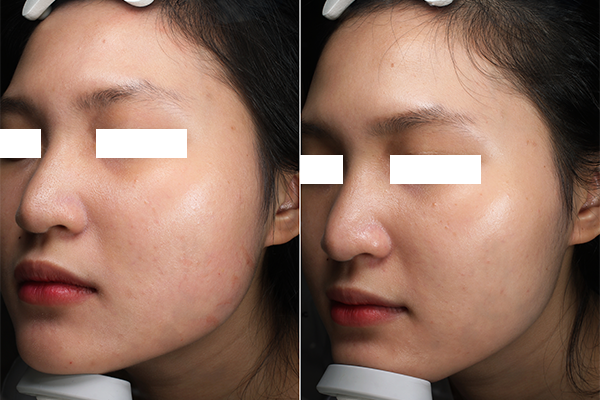 Thon gọn góc hàm với HIFU