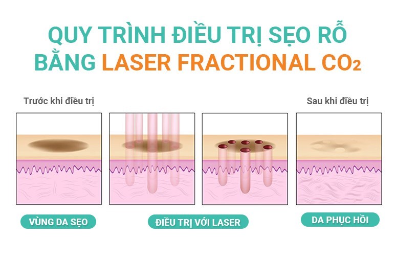 Quy trình điều trị sẹo rỗ bằng công nghệ laser fractional CO2