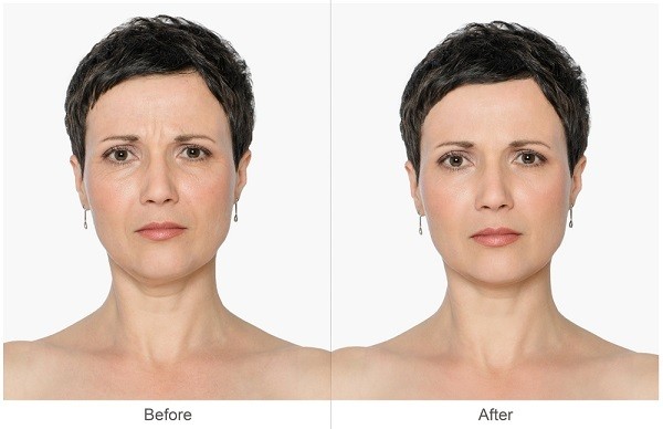 Trước và sau khi sử dụng liệu trình căng da mặt 