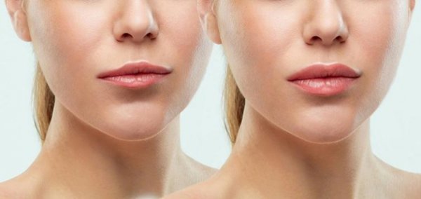 Fillers plump and enhance the charming lips
