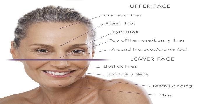 Botox effects on each area on face