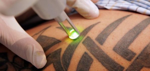 Q-スイッチレーザーによるタトゥー除去の様子