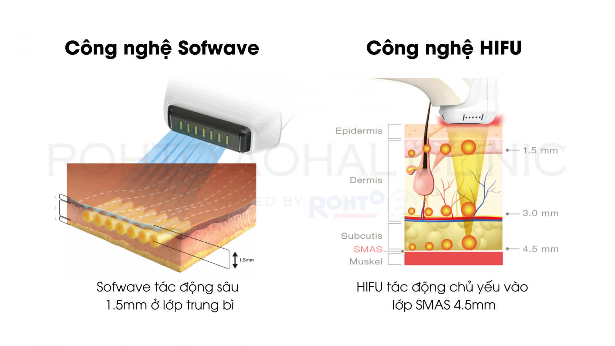 Công nghệ HIFU và Sofwave tác động lên da